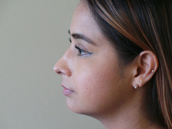 Rhinoplasty Patient 01 After 2