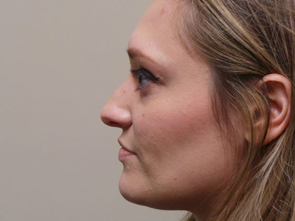 Rhinoplasty Patient 04 Before 1