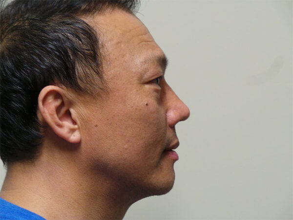 RHINOPLASTY PATIENT 13 After 1