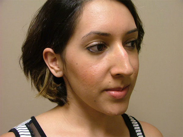 Rhinoplasty Patient 22 Before 2