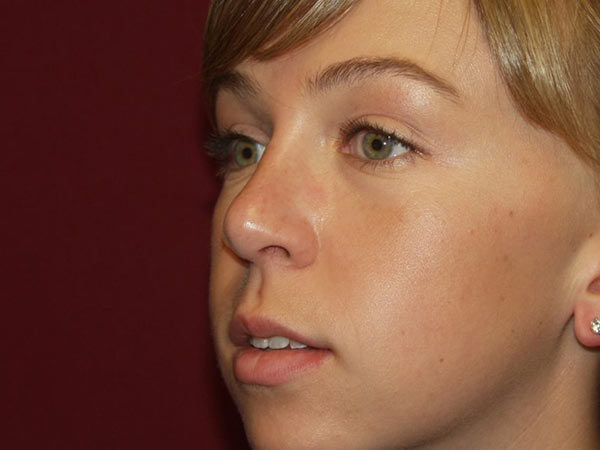 Rhinoplasty Patient 24 After 1