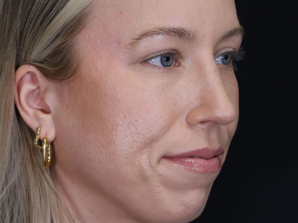 Rhinoplasty Patient 52 After 1