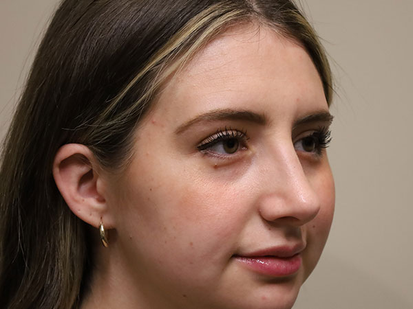 Rhinoplasty Patient 46 After 2