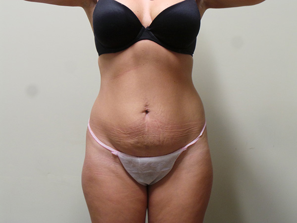 Tummy Tuck Before