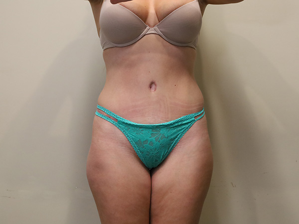 Tummy Tuck After