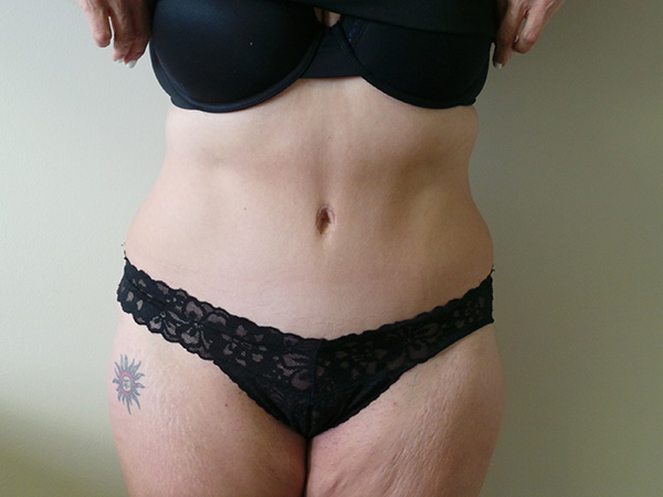 Tummy Tuck with Lipo Patient 1 After 1