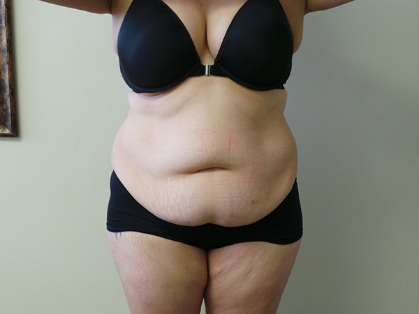 Tummy Tuck with Lipo Patient 1 Before 1